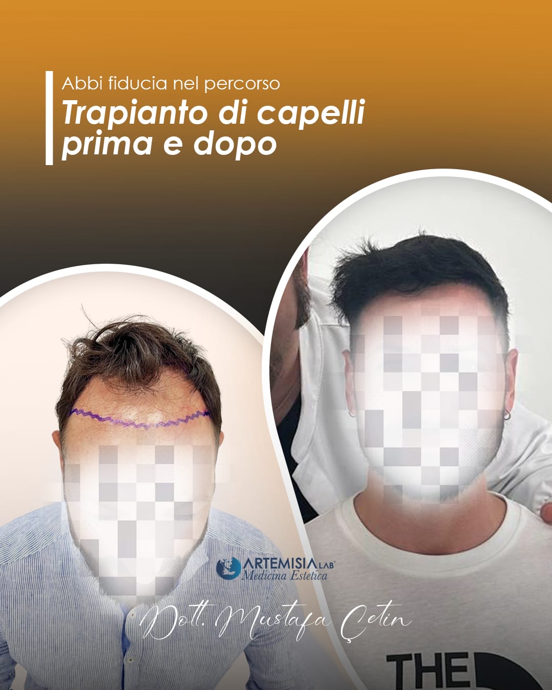 Trapianto di capelli prima e dopo, caso 1: paziente del Dott. Mustafa Çetin, volto oscurato