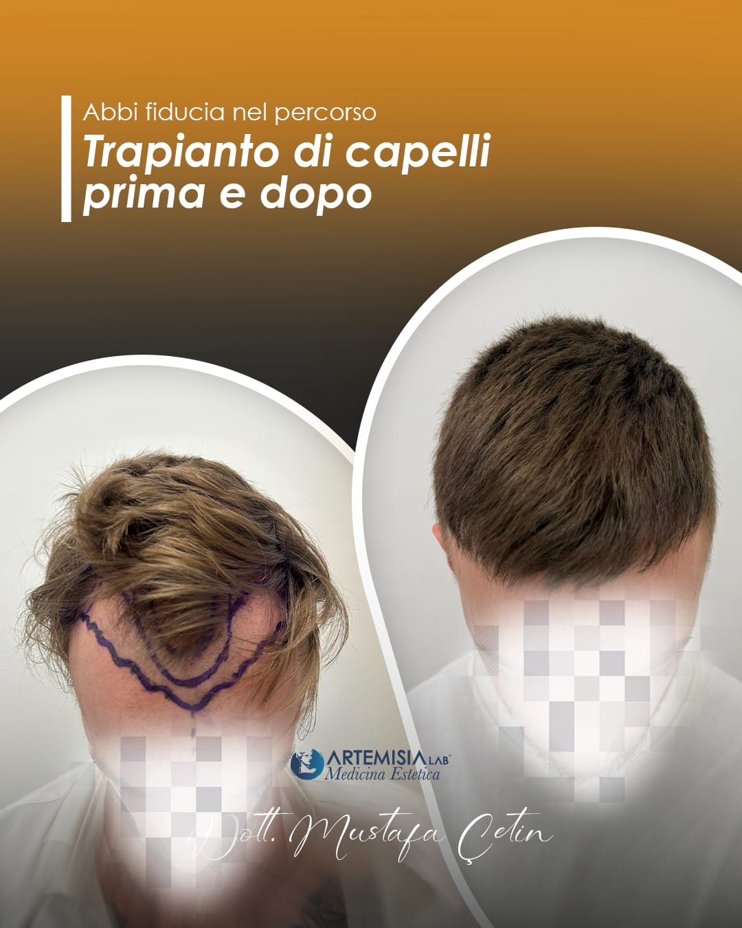 Trapianto di capelli prima e dopo, caso 2: paziente del Dott. Mustafa Çetin, volto oscurato