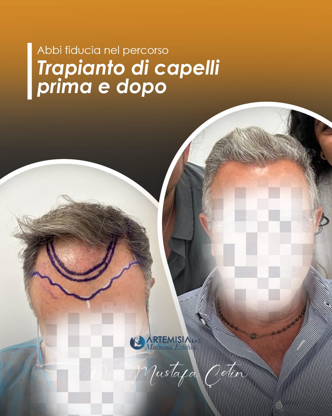 Trapianto di capelli prima e dopo, caso 3: paziente del Dott. Mustafa Çetin, volto oscurato