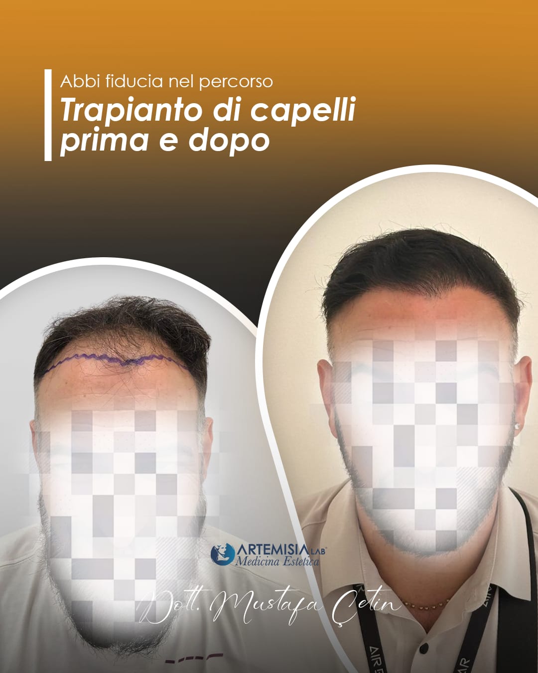 Trapianto di capelli prima e dopo, caso 4: paziente del Dott. Mustafa Çetin, volto oscurato